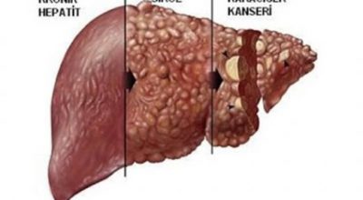 “Siroz Vakit Kaybedilmeden Tedavi Edilmelidir”